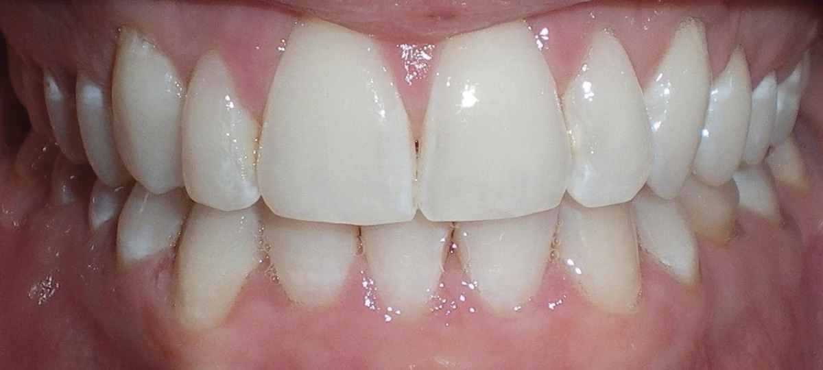 After treatment: the same case published by ClearCorrect.
