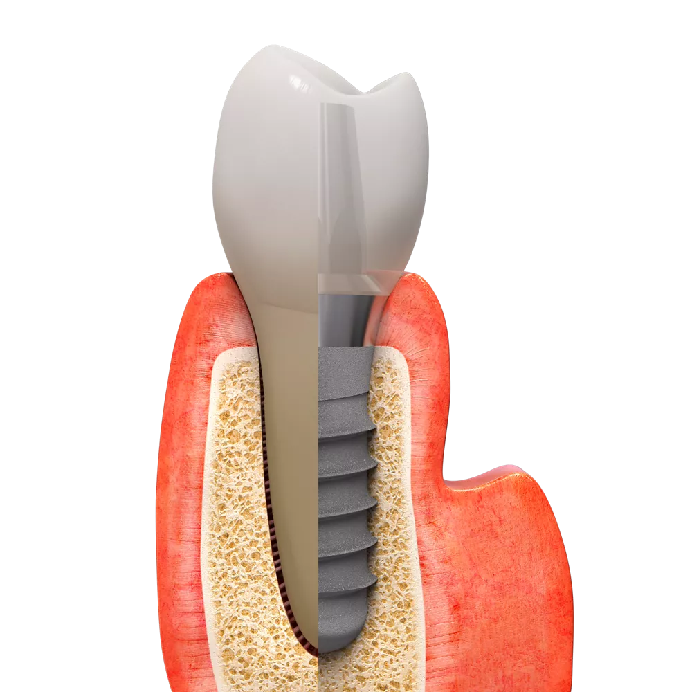 Straumann patient illustration: a natural tooth and an implant with a crown.